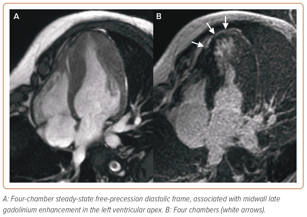 Figure 3 Cardiac Magnetic Resonance In Hypertrophic Cardiomyopathy